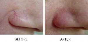 aging treatments anti thermo lo