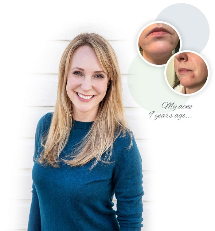 Natural Acne Treatment Natural Skincare & Acne Clinic Denver