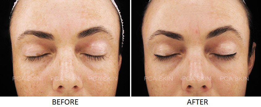 Chemical Peel and Microdermabrasion