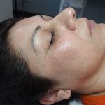 MicroNeedling Acne Scarring