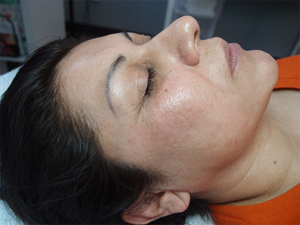 MicroNeedling Acne Scarring