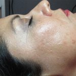 MicroNeedling Acne Scarring