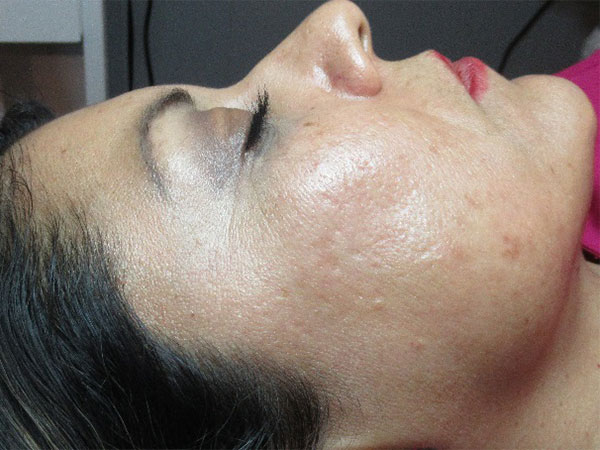 MicroNeedling Acne Scarring
