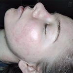 IPL Acne Scarring