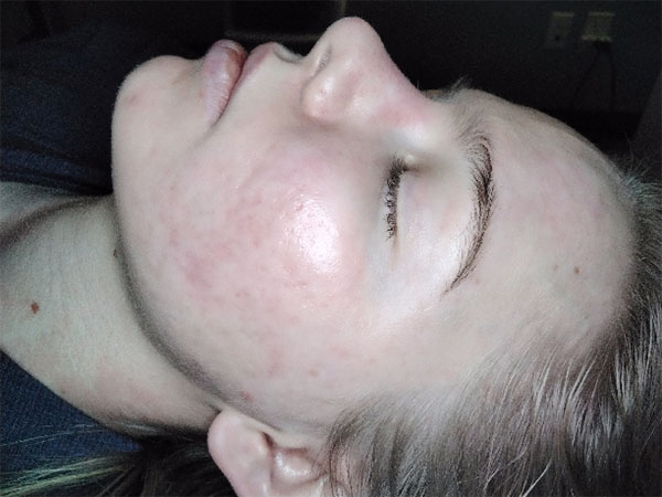 IPL Acne Scarring