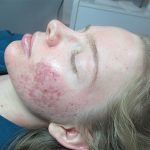IPL Acne Scarring