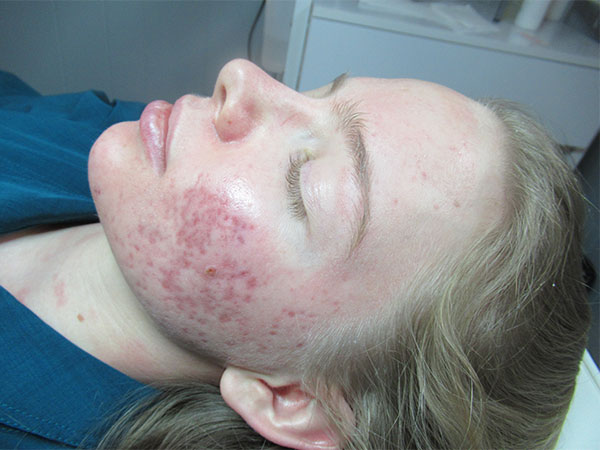 IPL Acne Scarring