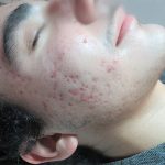 IPL Acne Scarring