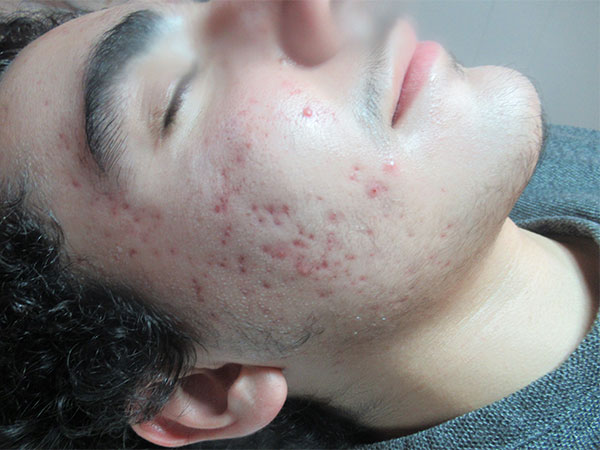 IPL Acne Scarring