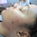 Acne Program