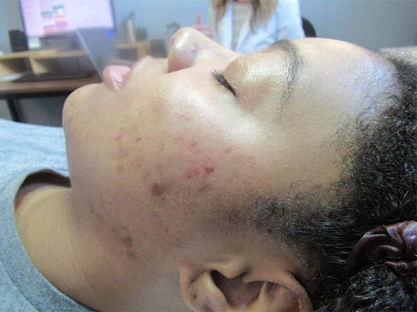 Acne Program