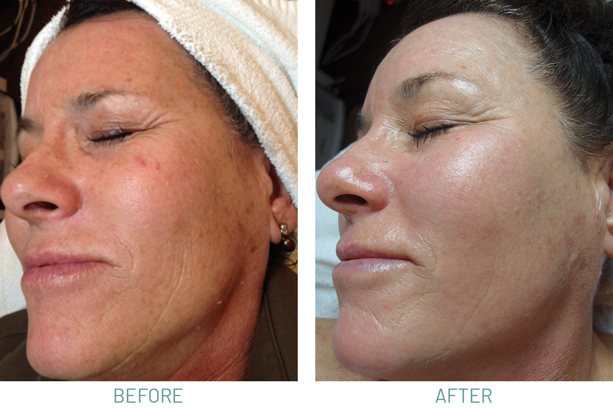 https://www.naturalskincareclinic.com/wp-content/uploads/2022/06/Microdermabrasion-Chemical-Peels-BEFOREAFTER.png