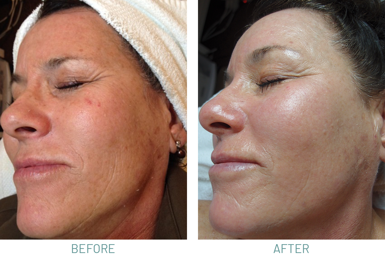 Microdermabrasion And Chemical Peels Natural Skincare Clinic