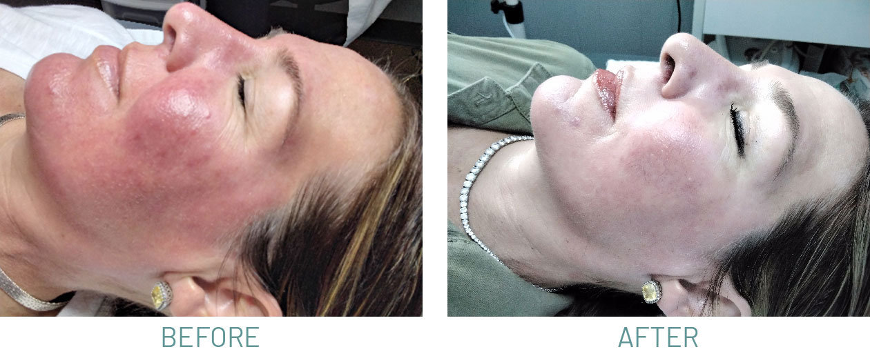 Rosacea-BEFORE&AFTER