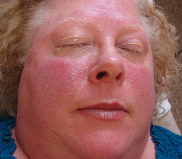 rosacea subtype 1