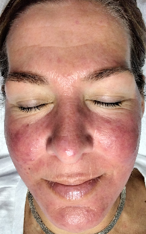 rosacea subtype 2