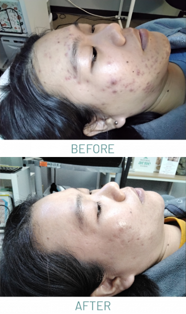 Acne-Light-Therapy