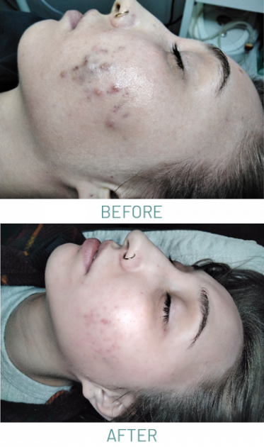 Acne-Peels