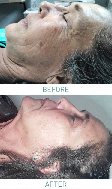 Micro Needling